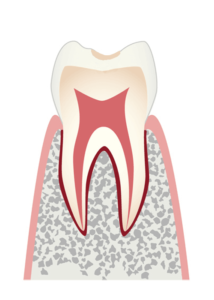 歯の表層（エナメル質）のむし歯